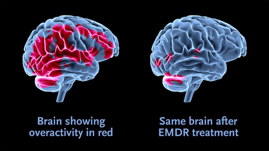 EDMR is used by inpatient drug rehabs Fort Lauderdale, Florida